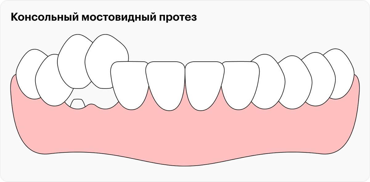 Консольный мостовидный протез крепится на один зуб. Этот зуб обтачивают, однако шинирования не происходит, ведь протез не соединяет два настоящих зуба друг с другом