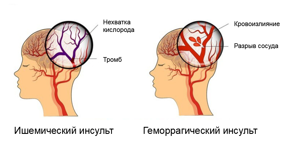 Иногда сложно отличить два вида инсульта друг от друга, поскольку некоторые симптомы схожи. Источник:&nbsp;op2lysis.com