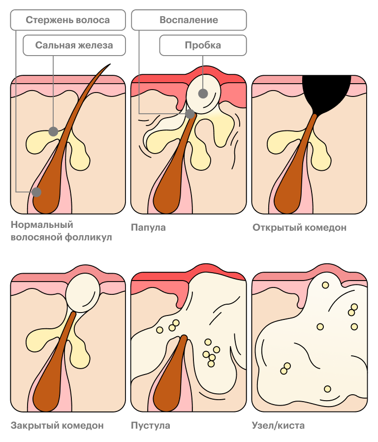 Как появляются прыщи. Прыщи комедоны угри акне. Конглобатная угревая сыпь. Подкожный прыщ комедон.