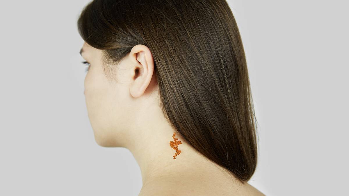 Стоит ли удалять невус Ядассона?