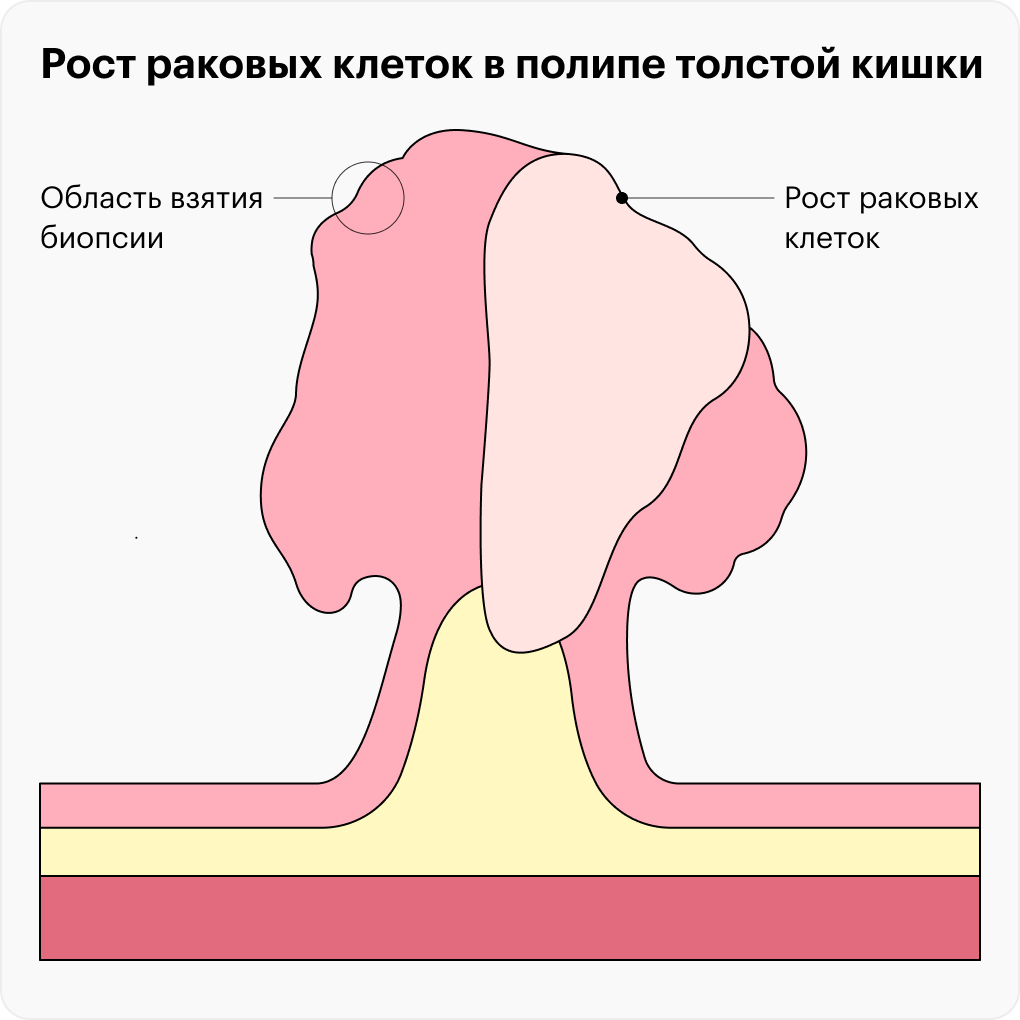 Сколько стоит колоноскопия в Израиле