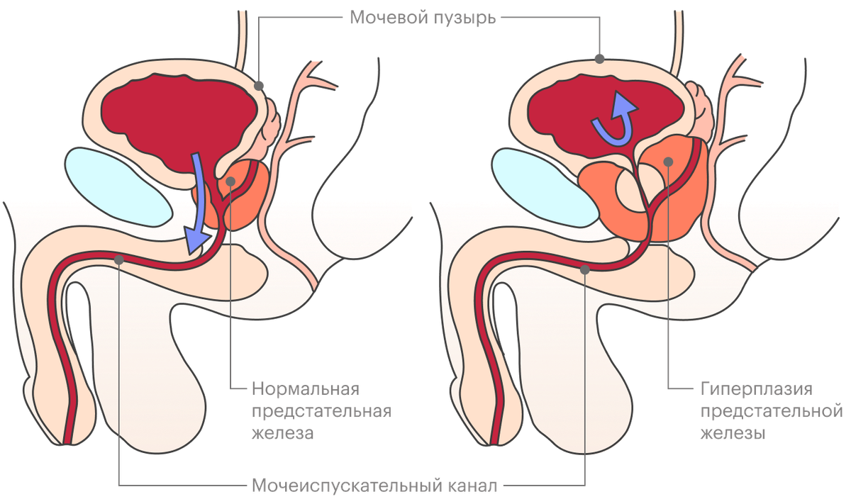 аденома простаты и сухой оргазм фото 11