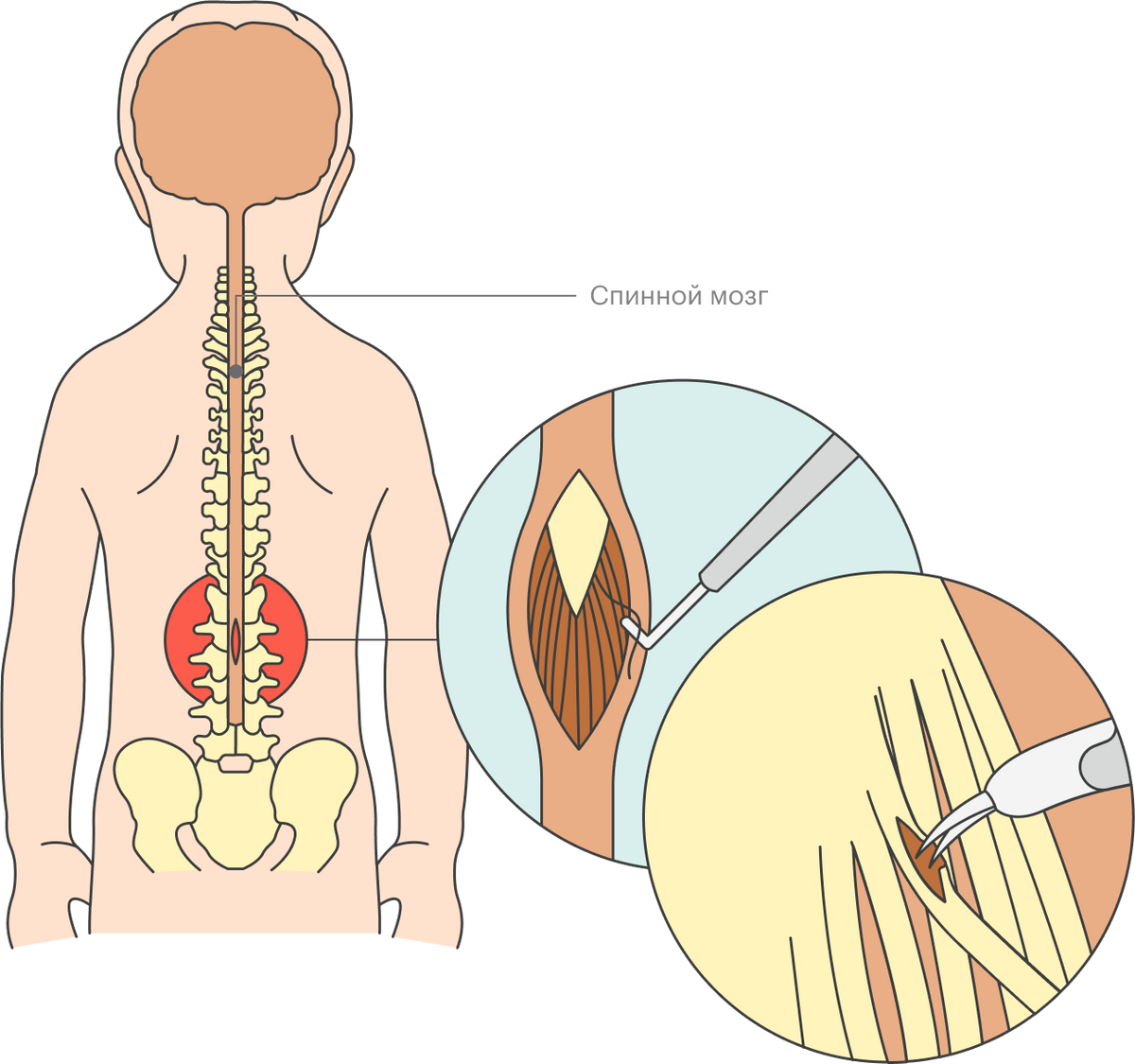 Во время СДР хирург делает небольшой разрез в поясничной части позвоночника и пересекает нервные волокна спинного мозга