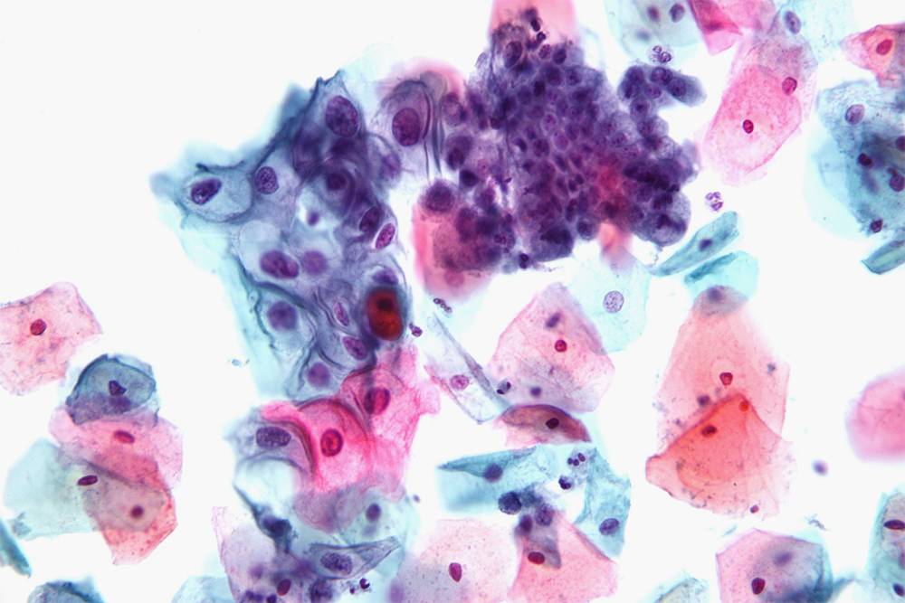 Мазок по Папаниколау под&nbsp;микроскопом. Крупные розовые эпителиальные клетки нормальные, а мелкие сине-фиолетовые могут оказаться предраковыми. Scienceline
