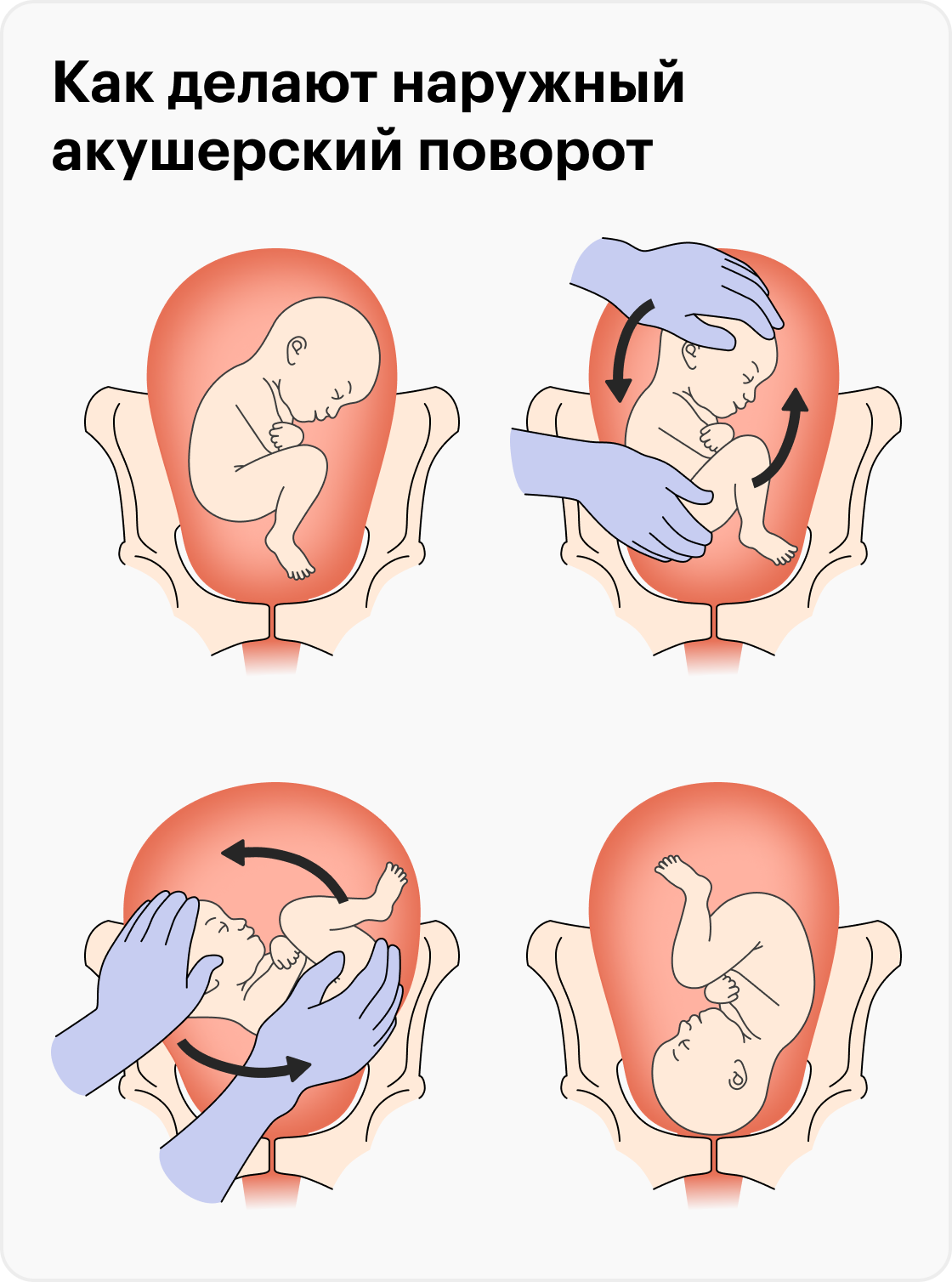 Тазовое предлежание переворот. Наружный акушерский поворот. Наружный акушерский поворот плода. Наружный акушерский поворот плода при тазовом. Комбинированный акушерский поворот.