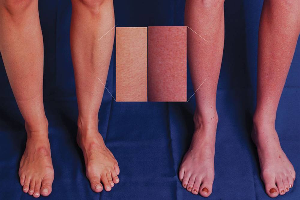 Один из симптомов СПОТ — изменение цвета кожи ног в положении стоя. Слева — здоровый человек, справа — пациентка со СПОТ, на ногах которой появились заметные темно-красные пятна. Источник:&nbsp;ncbi.nih.gov