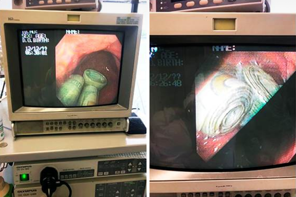 Денежный безоар в желудке на мониторе прибора в операционной. Источник: Колумбийский журнал гастроэнтерологии