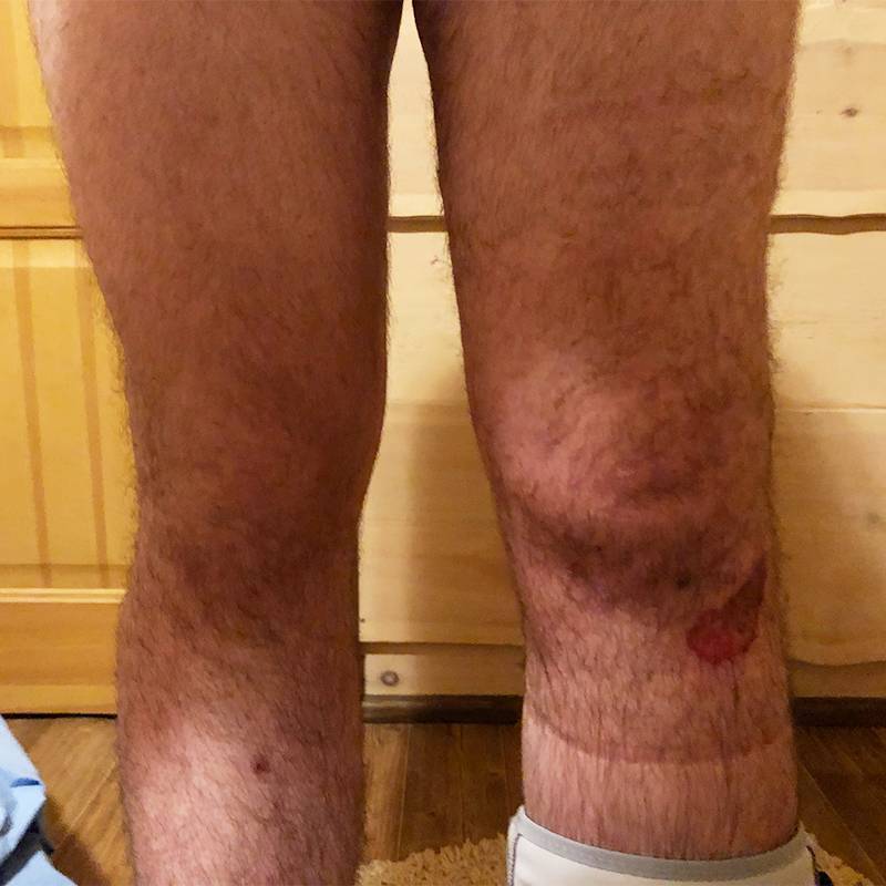 Вот так травмированное колено выглядело сразу после травмы