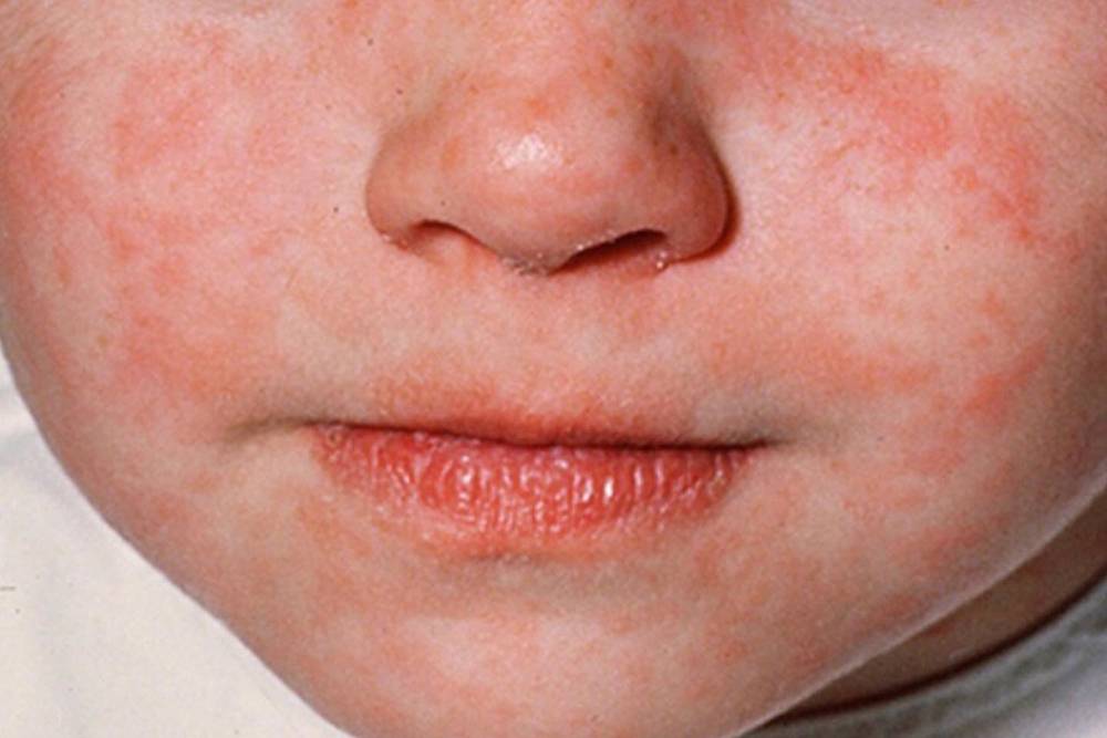 Коревая сыпь на лице ребенка. Источник:&nbsp;Кmayoclinic.org