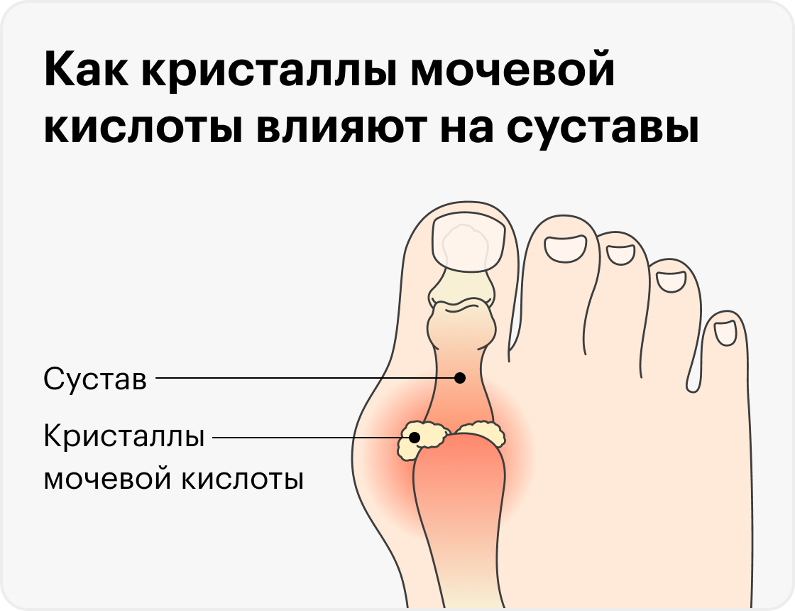 Стол при подагре и повышенной мочевой