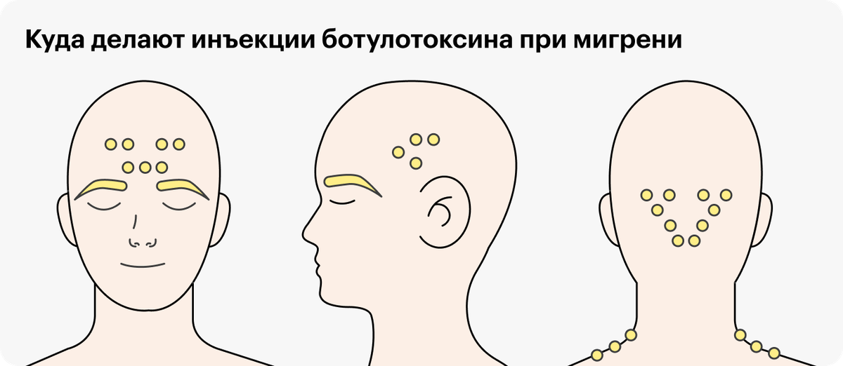 Схема введения ботулотоксина при мигрени
