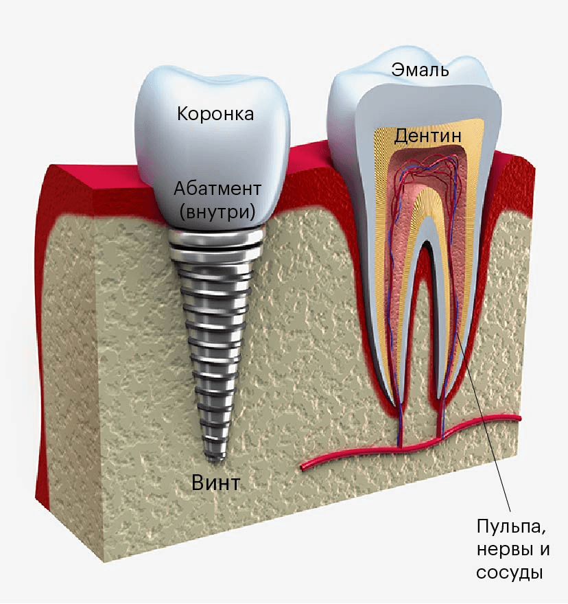 Имплантат похож на схематичный зуб. Главное отличие — внутри коронки нет кровеносных сосудов и нервов, а вместо живого корня — металлический винт