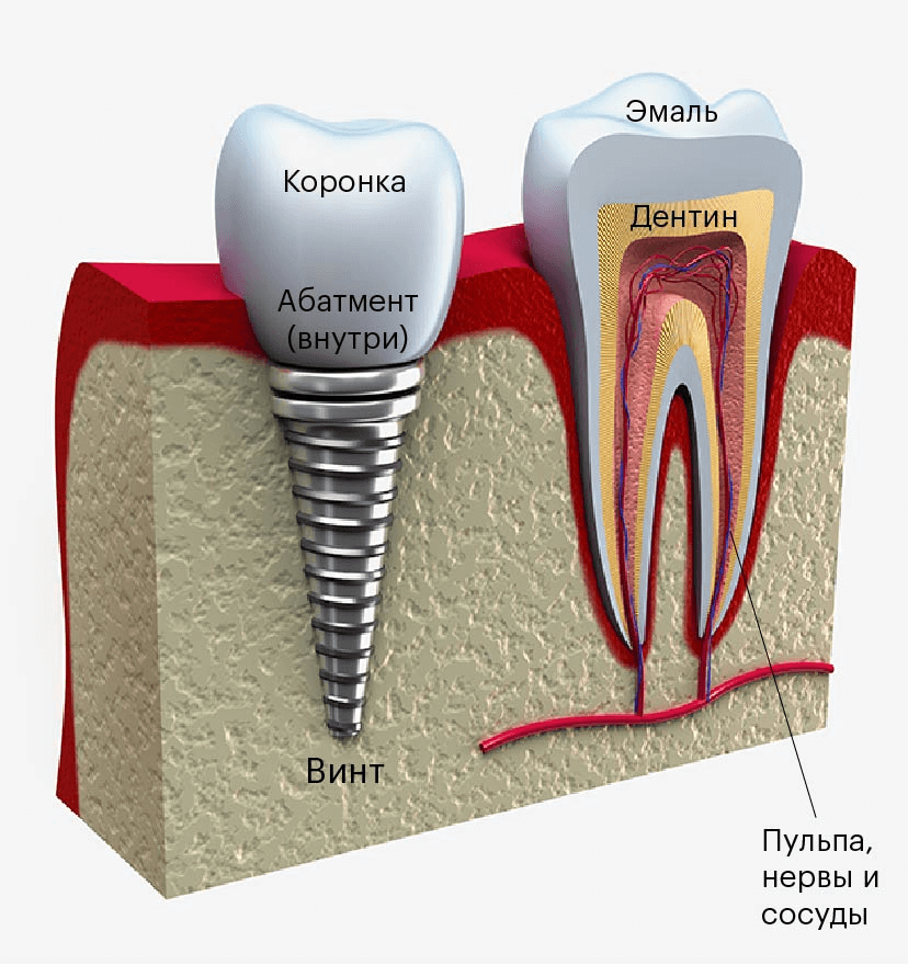 Как выглядит зубной штифт фото
