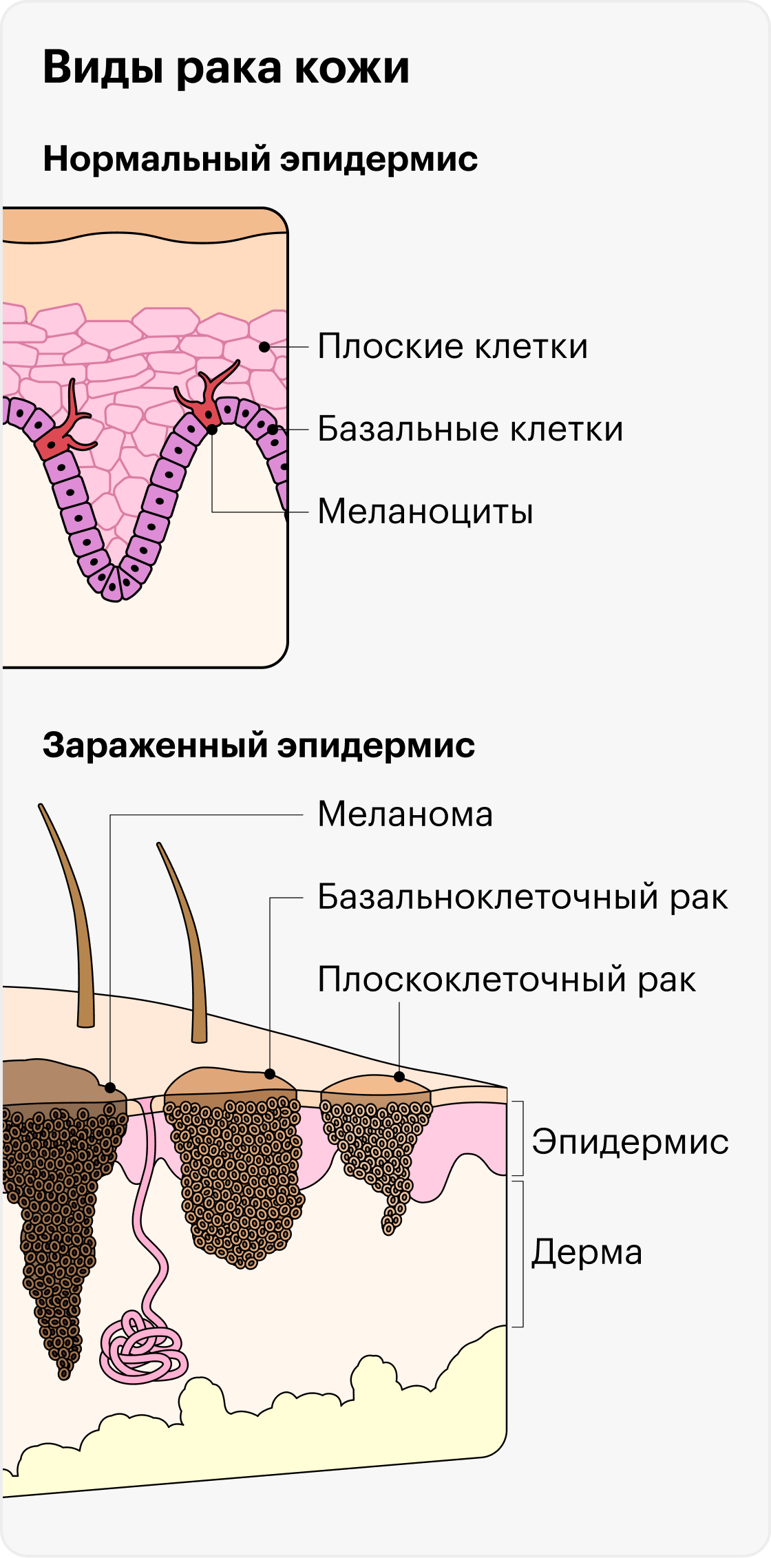 Рак кожи: симптомы, как выглядит, признаки, стадии, лечение