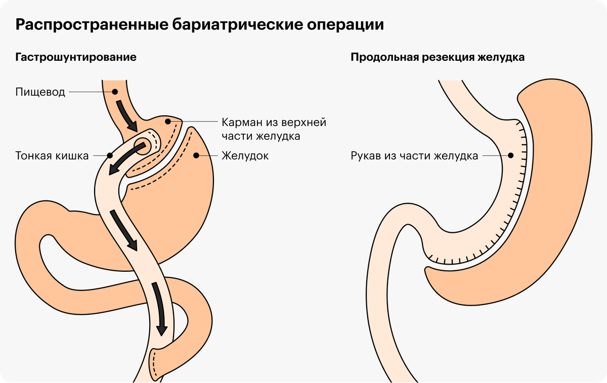 Что такое резекция желудка для похудения. Бариатрическая операция. Бариатрия виды операций. Бариатрическая операция осложнения.