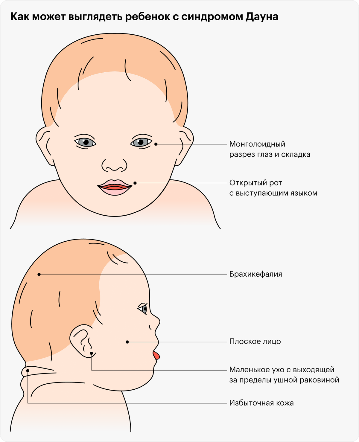 Люди с синдромом Дауна похожи между собой, потому что имеют сходные черты внешности: косой разрез глаз, маленький рот с выступающим языком, маленькие уши, уплощенный затылок и лицо, складки на задней поверхности шеи. Эти черты могут быть выражены в разной степени или отсутствовать совсем