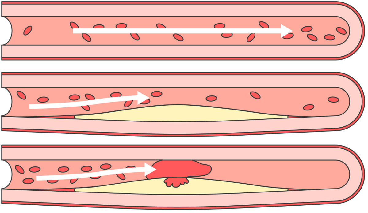 Атеросклеротические бляшки могут разрушаться, тогда содержимое попадает в кровь, что приводит к тромбозу