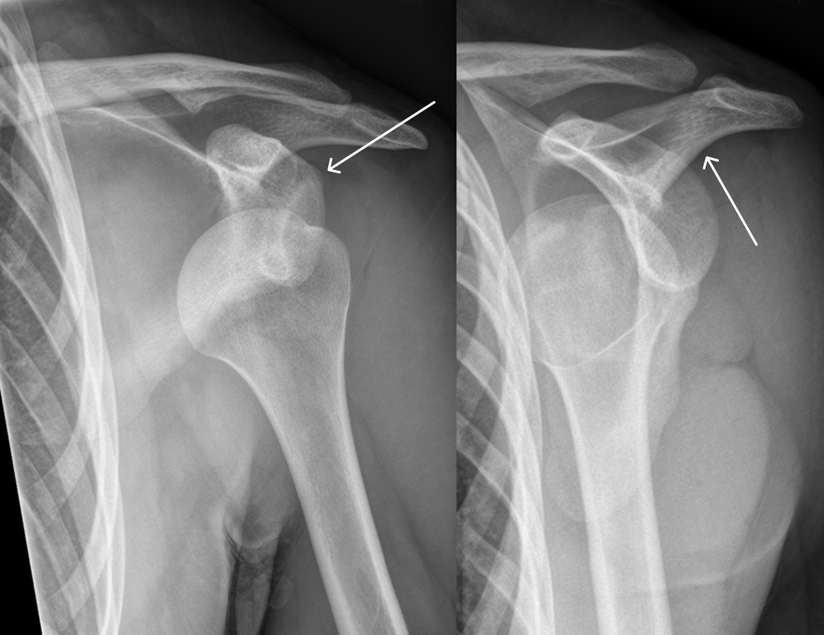 Вывих плеча на рентгенограмме: и на правом, и на левом снимке видно, что головка плечевой кости ушла со своего места в суставной впадине плечевого сустава. Стрелкой показано примерное расположение головки кости в норме. Источник: Hellerhoff / Wikimedia