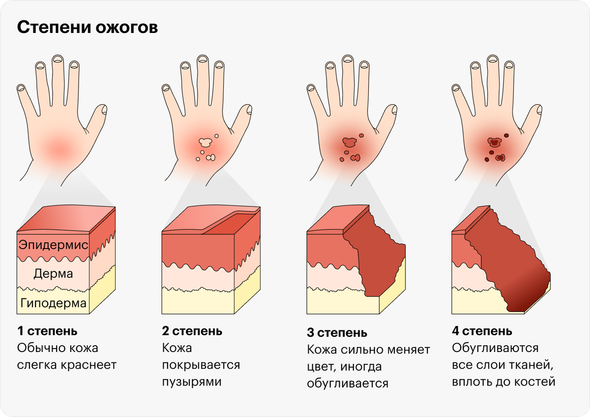 Кровать при ожогах как называется