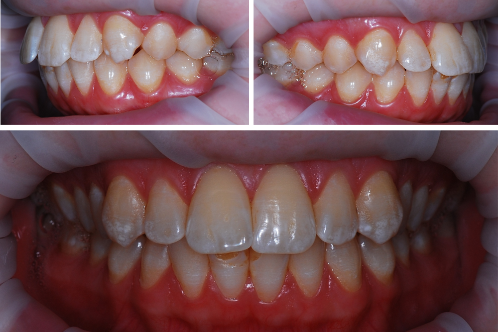 Пациент с ровными зубами и бипротрузией, то есть слишком сильным наклоном зубов вперед
