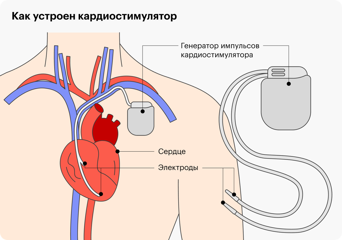 Если стоит кардиостимулятор можно. Двухкамерный кардиостимулятор. Кардиостимулятор операция. Однокамерный кардиостимулятор.