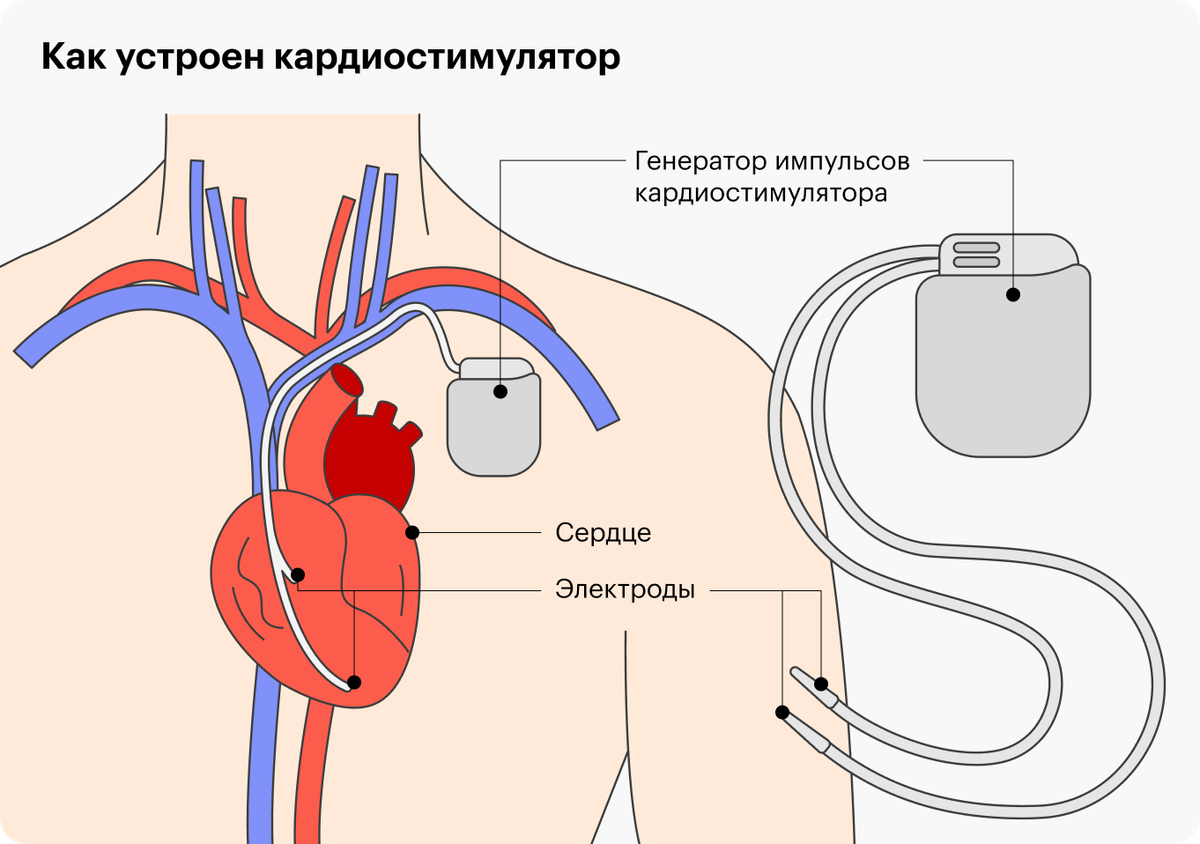 Как выглядит кардиостимулятор для сердца фото