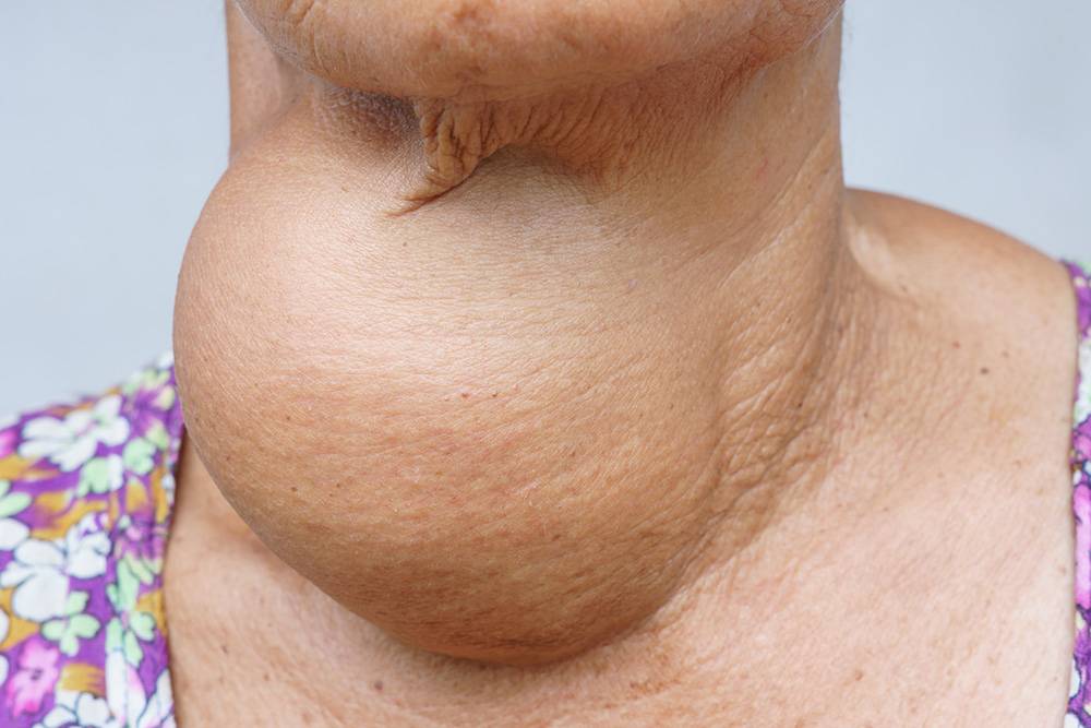 Иногда щитовидная железа разрастается настолько сильно, что объем зоба становится больше самой шеи. Источник: chatuphot / Shutterstock
