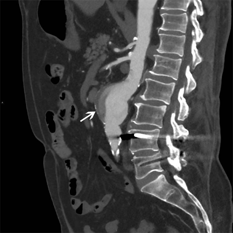 Аневризма брюшного отдела аорты на компьютерной томографии, видно расширение сосуда. Источник: MSD