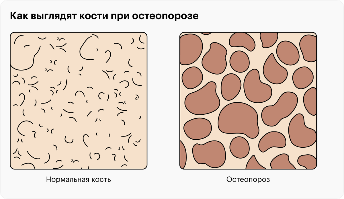 По мере развития остеопороза кости становятся более рыхлыми и хрупкими — это приводит к уменьшению роста и изменению осанки