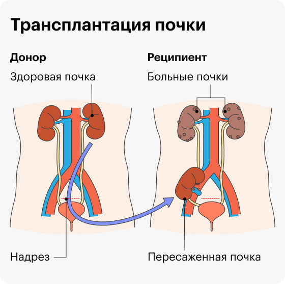 Реципиент трансплантация. Трансплантология почки. Трансплантация почки схема. Гетеротопическая трансплантация почки.