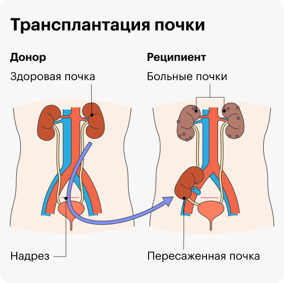 Трансплантология почки. Трансплантация почки схема. Гетеротопическая трансплантация почки. Реципиент трансплантация