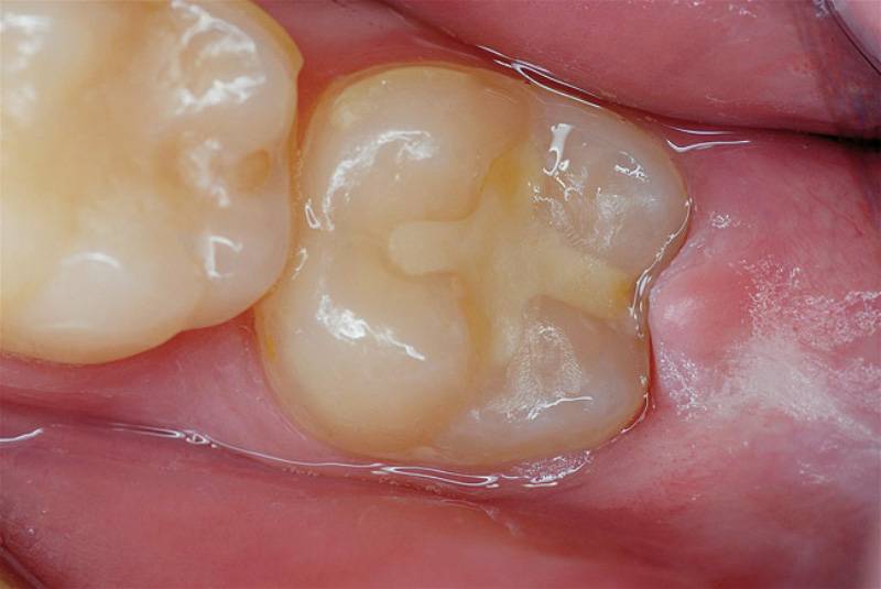 Слева: здоровый зуб. Справа: зуб, запломбированный стеклоиономерным цементом. Фото:&nbsp;freegoalet.com