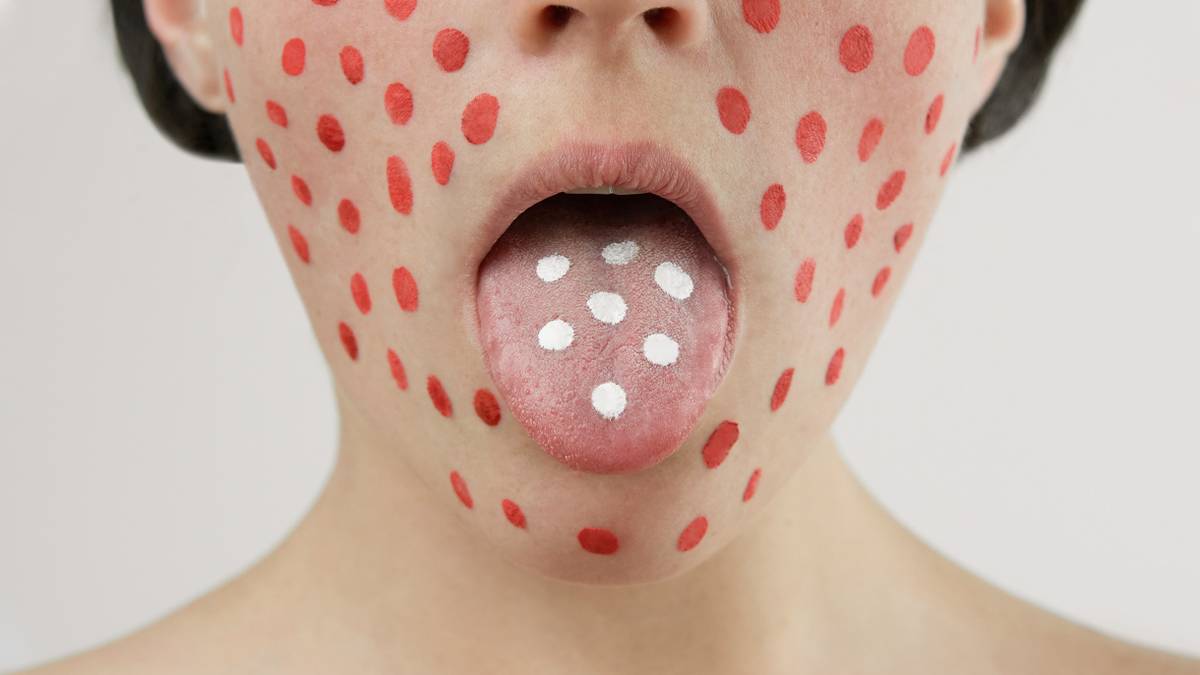 Скарлатина у детей: симптомы, лечение, признаки, как проявляется ...