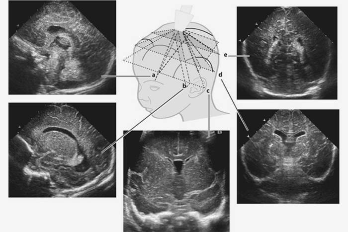 Нейросонография — это фактически УЗИ головного мозга. Орган смотрят через отверстие родничка, оценивают размеры и расположение разных структур. Источник: radiologykey.com