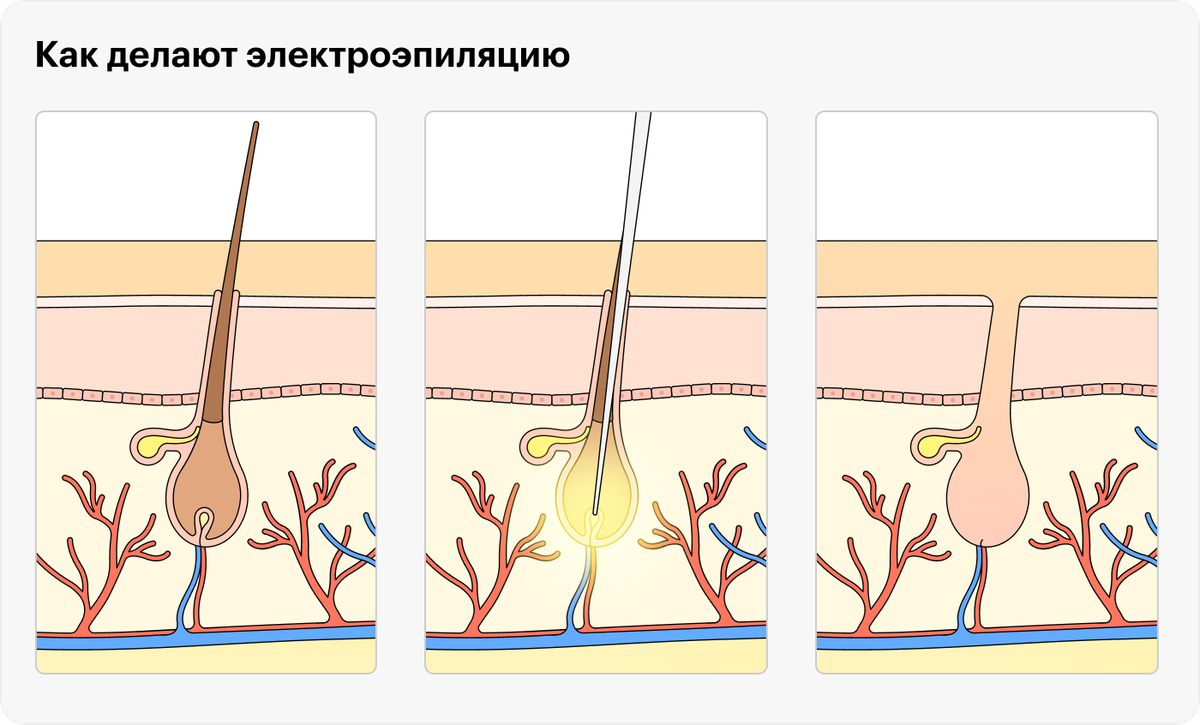 Бизнес план электроэпиляция