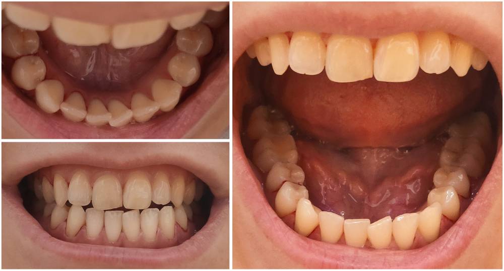 Фото зубов после процедуры