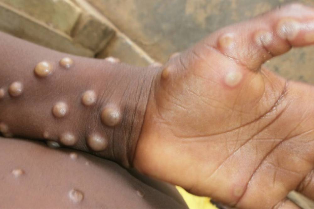 Как выглядит оспа обезьян. Это сыпь на смуглой коже. Источник: CDC