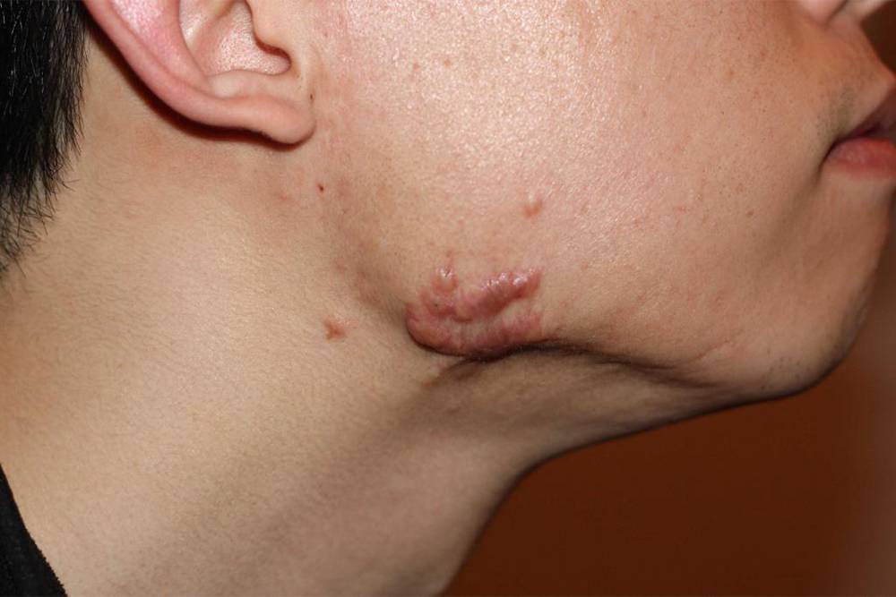 Келоидный рубец на лице. Источник: сайт компании Autogear