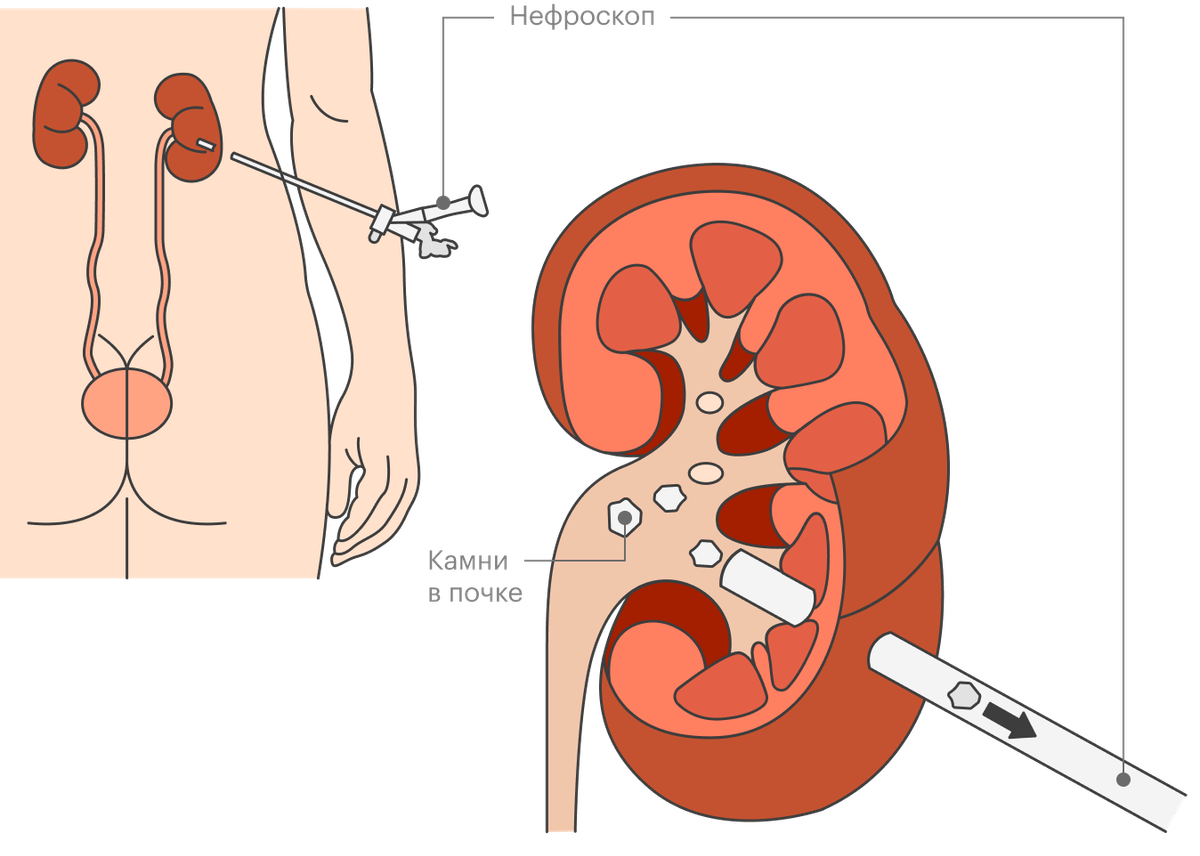 Как камень выходит из почки у мужчин схема