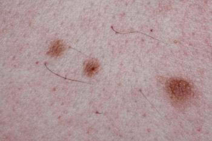 Родинки на теле: виды, какие опасны, профилактика меланомы
