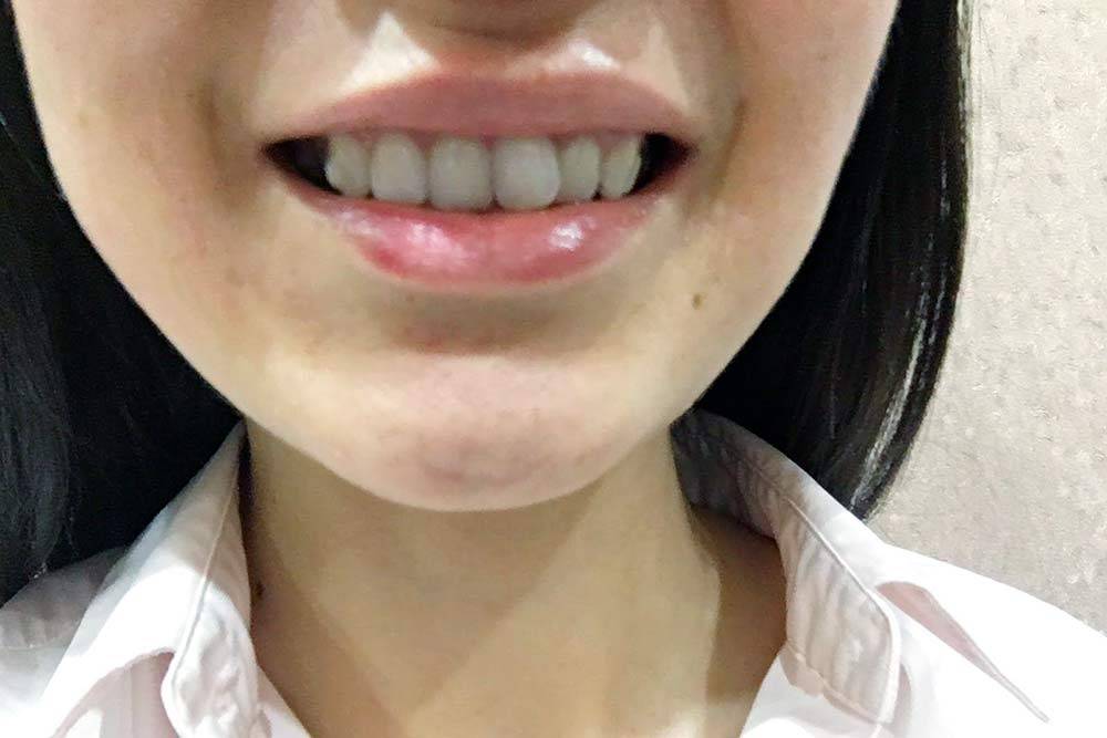 Элайнеры для выравнивания зубов: сколько стоят, что лучше для ...