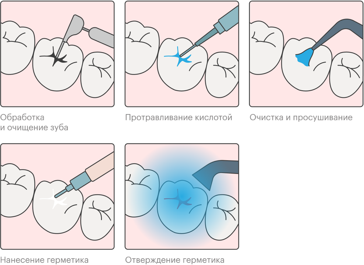 Герметизация фиссур картинки