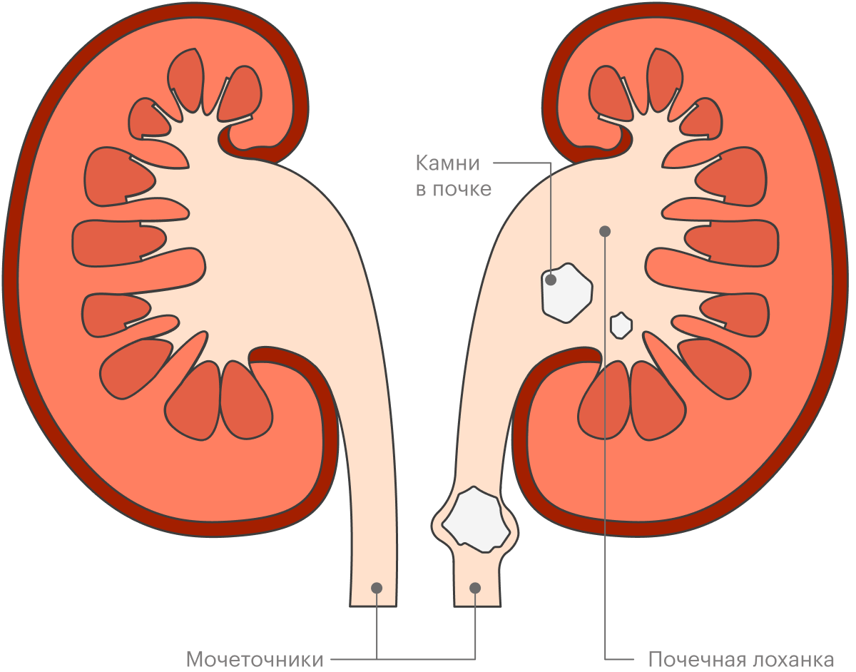 Какие камни в почках. Как выглядят камни в почках.
