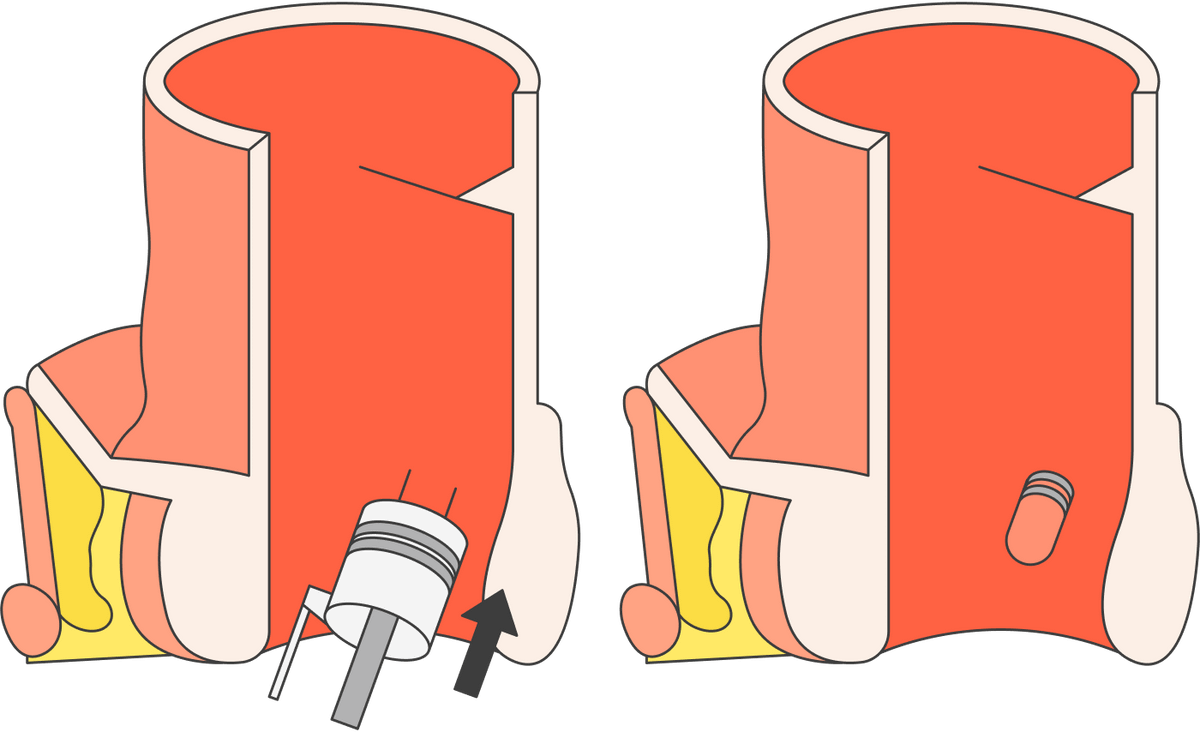 При&nbsp;лигировании на геморроидальный узел надевают латексное колечко, чтобы пережать кровоток. После этого узел должен отвалиться сам. Источник: Sakurra / Shutterstock