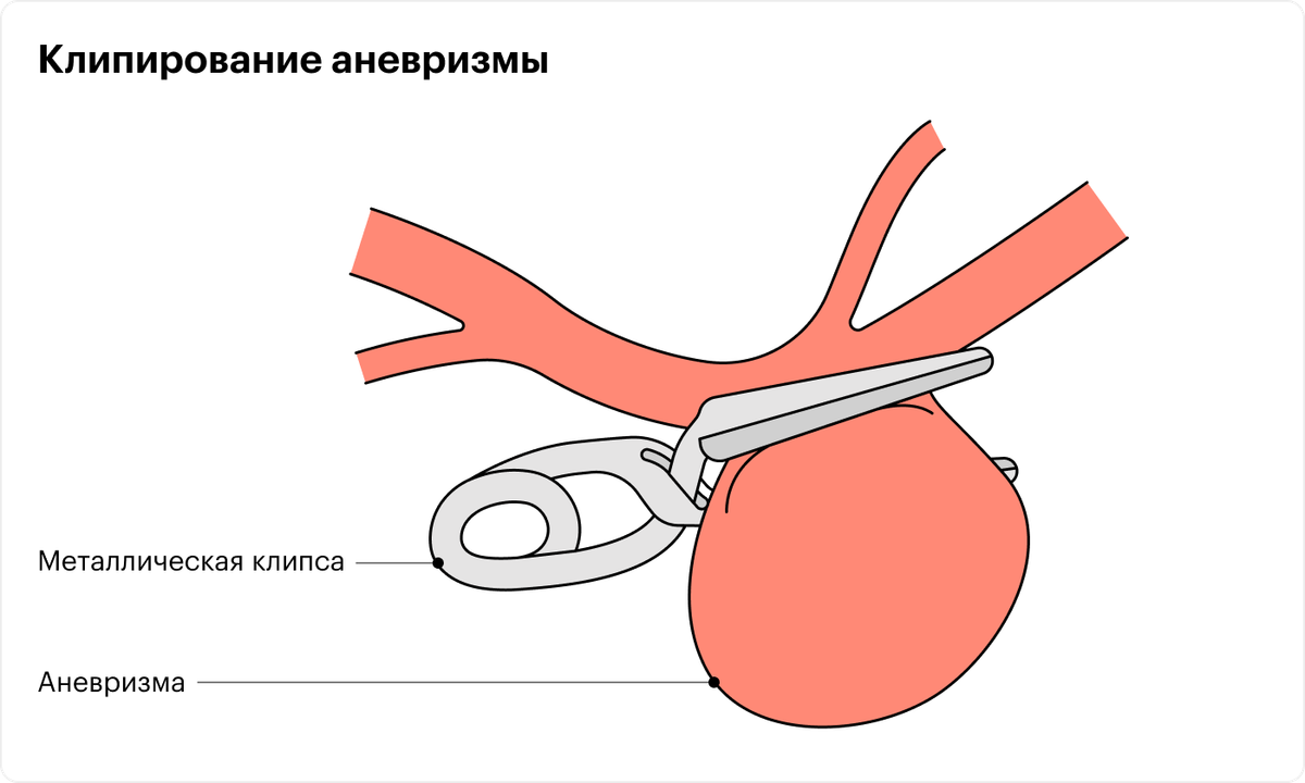 Хирург делает отверстие в черепе и через него подбирается к аневризме