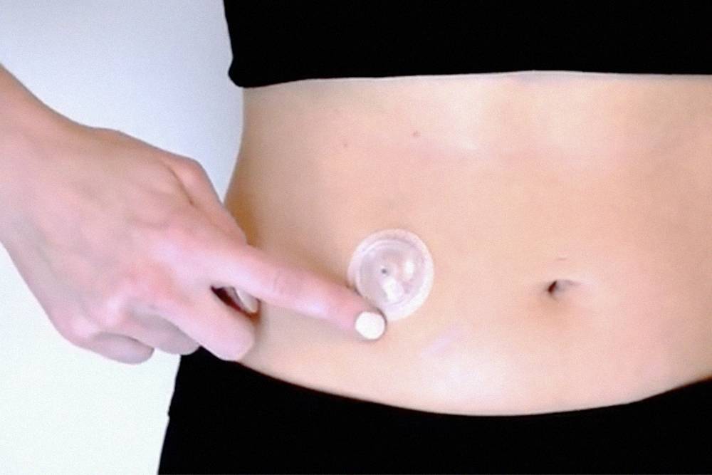 Инъекционный порт на коже. Источник: insulinaportatil.com.br