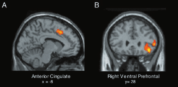 Мозг человека, которого отвергли. На изображении слева — повышенная активность передней поясной коры. Справа — чрезвычайно активная правая вентральная префронтальная кора. Источник:&nbsp;researchgate.net