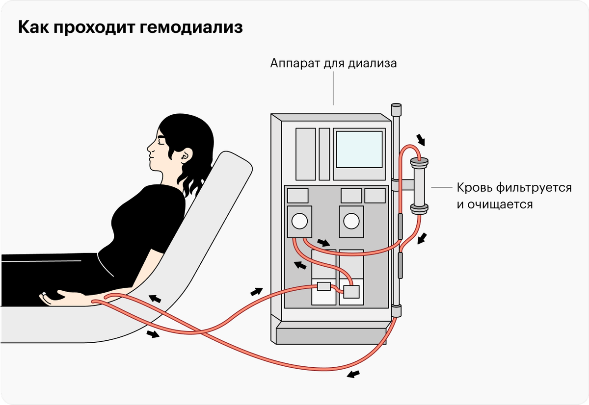 Что такое гемодиализ и зачем он нужен