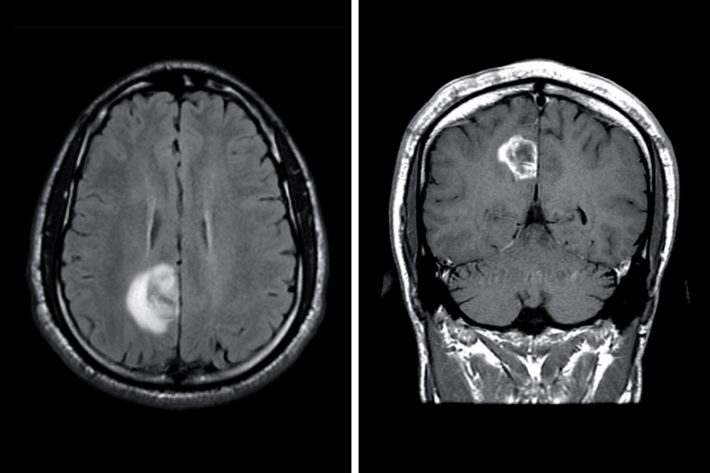 Причиной эпилепсии могут быть различные структурные изменения. Здесь на снимках видна опухоль — глиобластома, — которая вызывала эпилептические приступы. Источник: futuremedicine.com