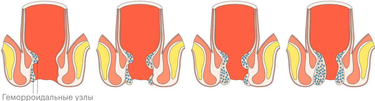 На каком стуле сидеть при геморрое